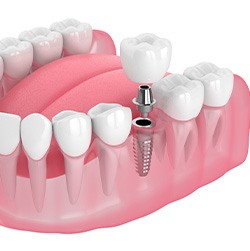 Illustration of a single dental implant