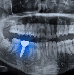 An X-ray of a jaw with a dental implant