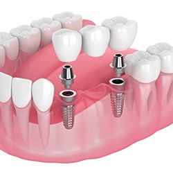 Illustration of an implant bridge