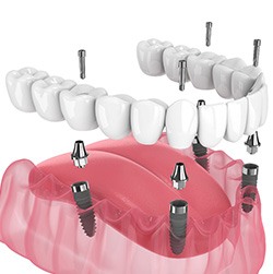 Illustration of an implant denture