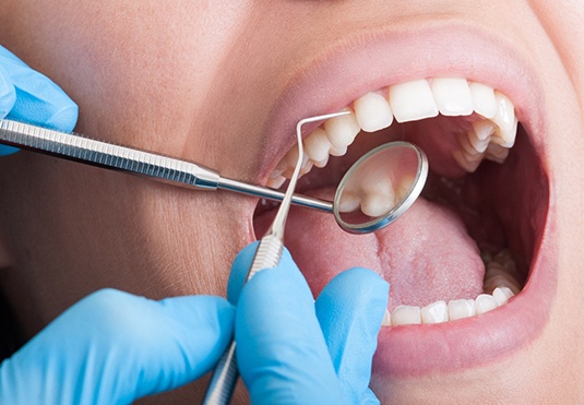 A closeup of a mouth receiving a dental checkup