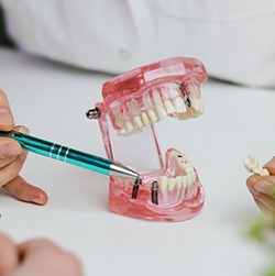 Because they’re permanently attached to your jawbone, dental implants can save you money over time on replacement costs