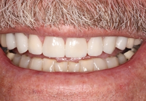 Close up of smile after failing bridge has been replaced