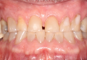 Close up of smile with failing bridge before treatment
