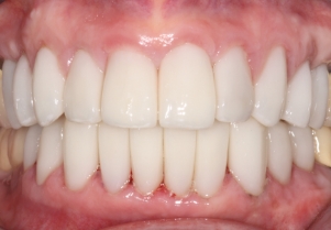 Close up of smile after failing bridge has been replaced