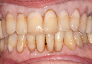 Close up of smile with failing bridge before treatment