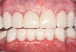 Close up of smile after failing bridge has been replaced