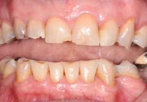 Close up of smile with failing bridge before treatment