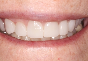 Close up of smile after failing bridge has been replaced