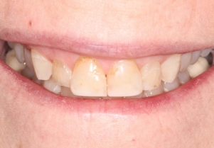Close up of smile with failing bridge before treatment