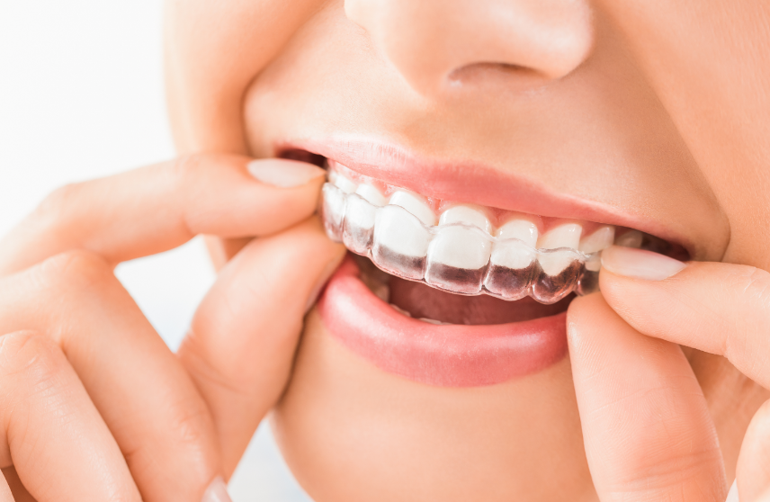 Woman fitting clear aligner